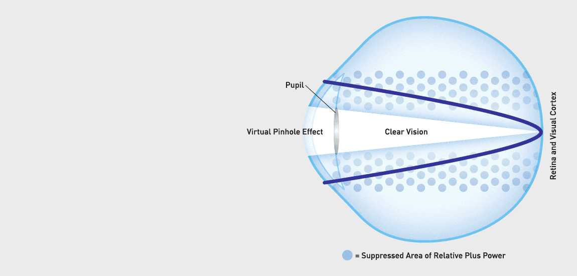Natural Vue provides clear distance, intermediate, and near vision.