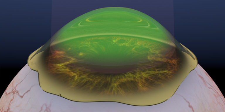 CrossLinking Treatment for Keratoconus or Corneal Ectasia CrossLinking Treatment for Keratoconus or Corneal Ectasia