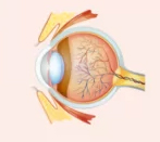 myopia cross-section
